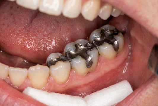 Dentists' Exposure to Dental Amalgam